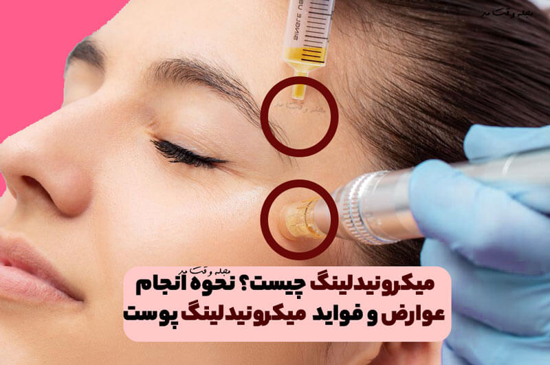 میکرونیدلینگ چیست؟ نحوه انجام، عوارض و فواید Microneedling پوست را بدانید!