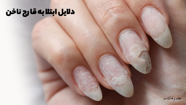 دلایل ابتلا به قارچ ناخن