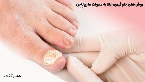 روش های جلوگیری از ابتلا به عفونت قارچ ناخن