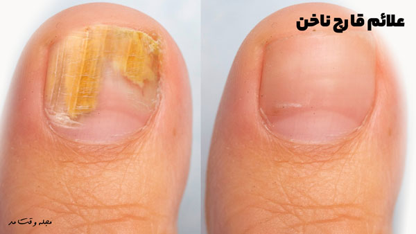 علائم قارچ ناخن