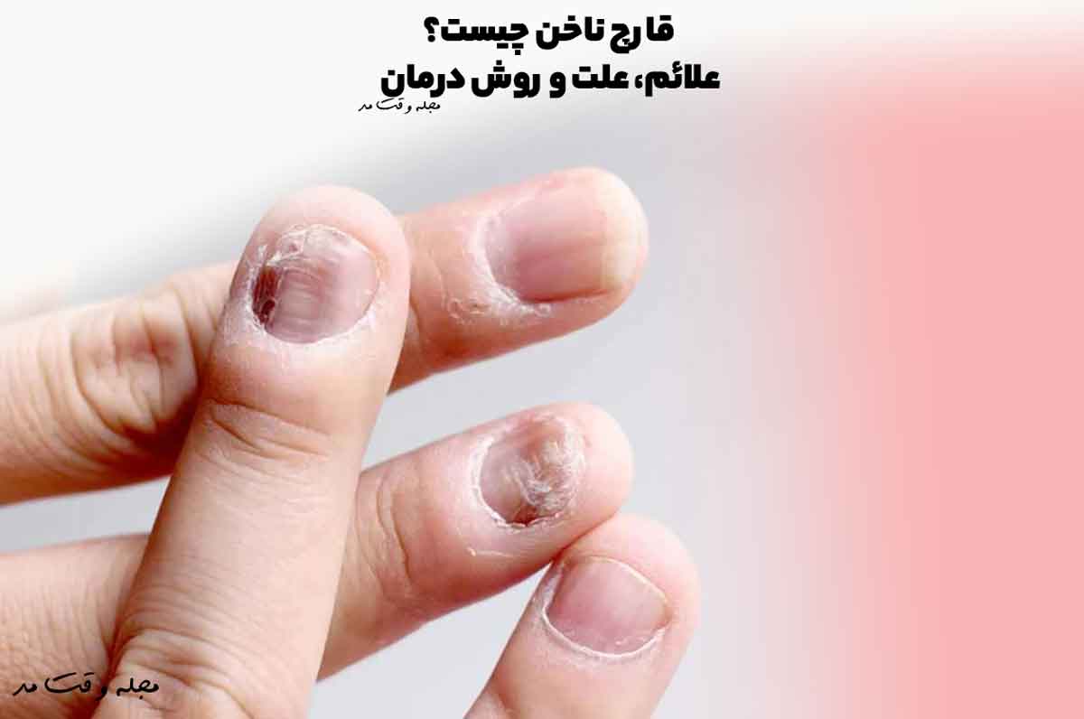 قارچ ناخن چیست؟ علائم، علت و روش درمان عفونت قارچ ناخن را بدانید!